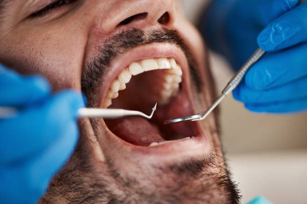 Best Chipped Tooth Repair Near Me  in Alamo, TX